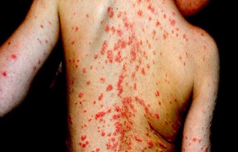 Paneles decorativos para paredes home: Sintomas de la culebrilla