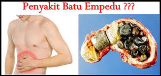 batu empedu batu empedu