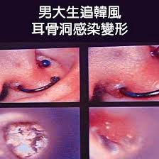 男大生追韓風 耳骨洞感染變形