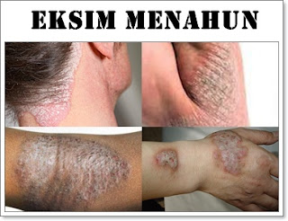 Bagaimana eksim menahun dengan cepat hilang dengan obat herbal