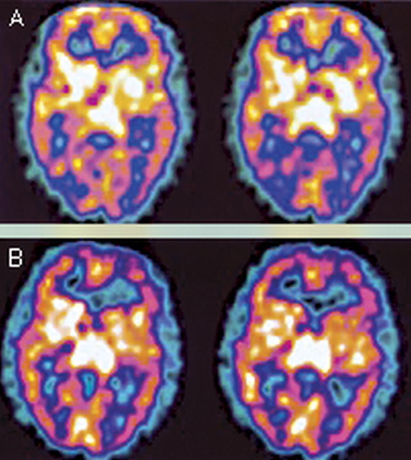 LOOKING AT LYME DISEASE MSIDS WHAT CAUSES WHITE MATTER LESIONS IN THE BRAIN OF PATIENTS WITH