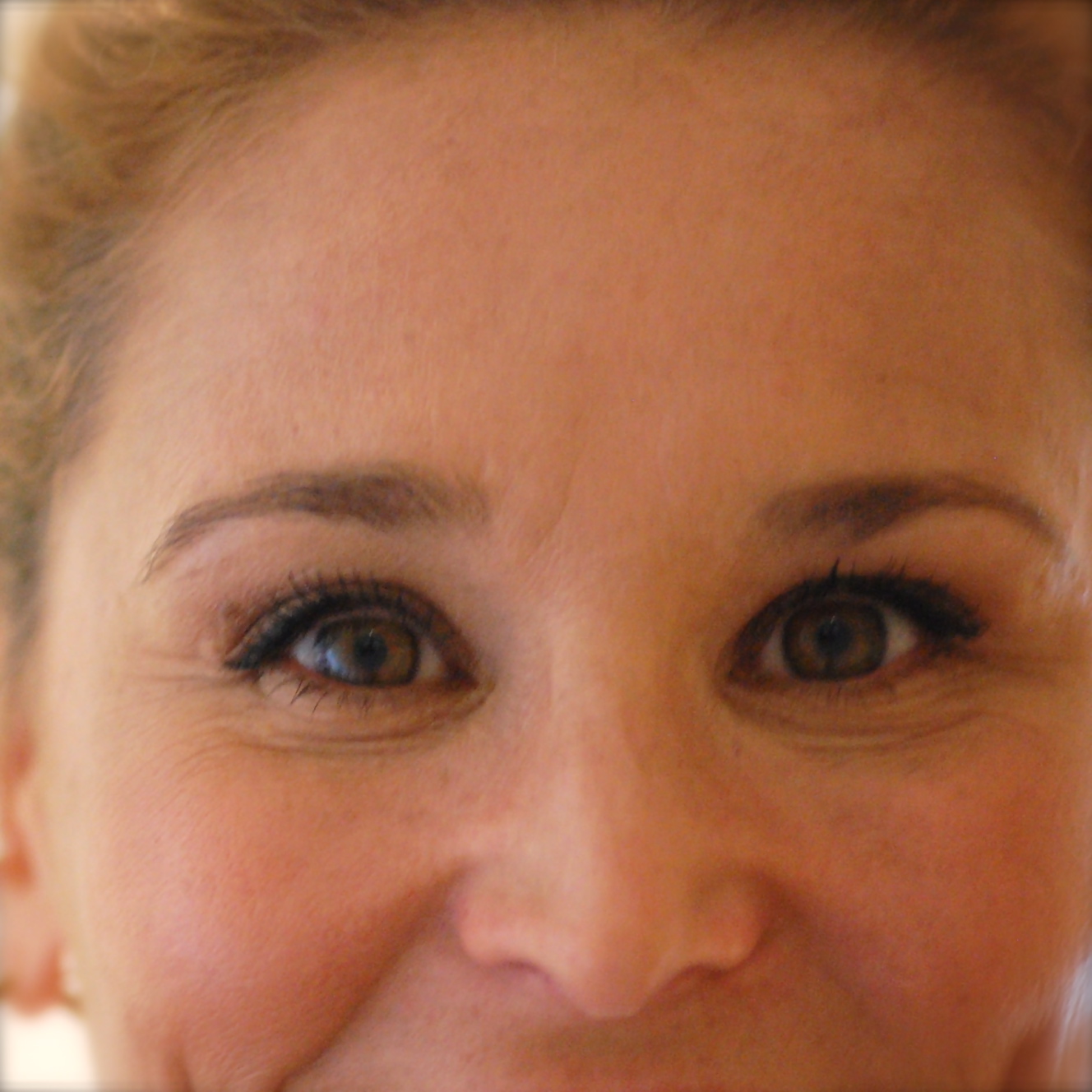 Hypothyroid Hypothyroid Eyebrows