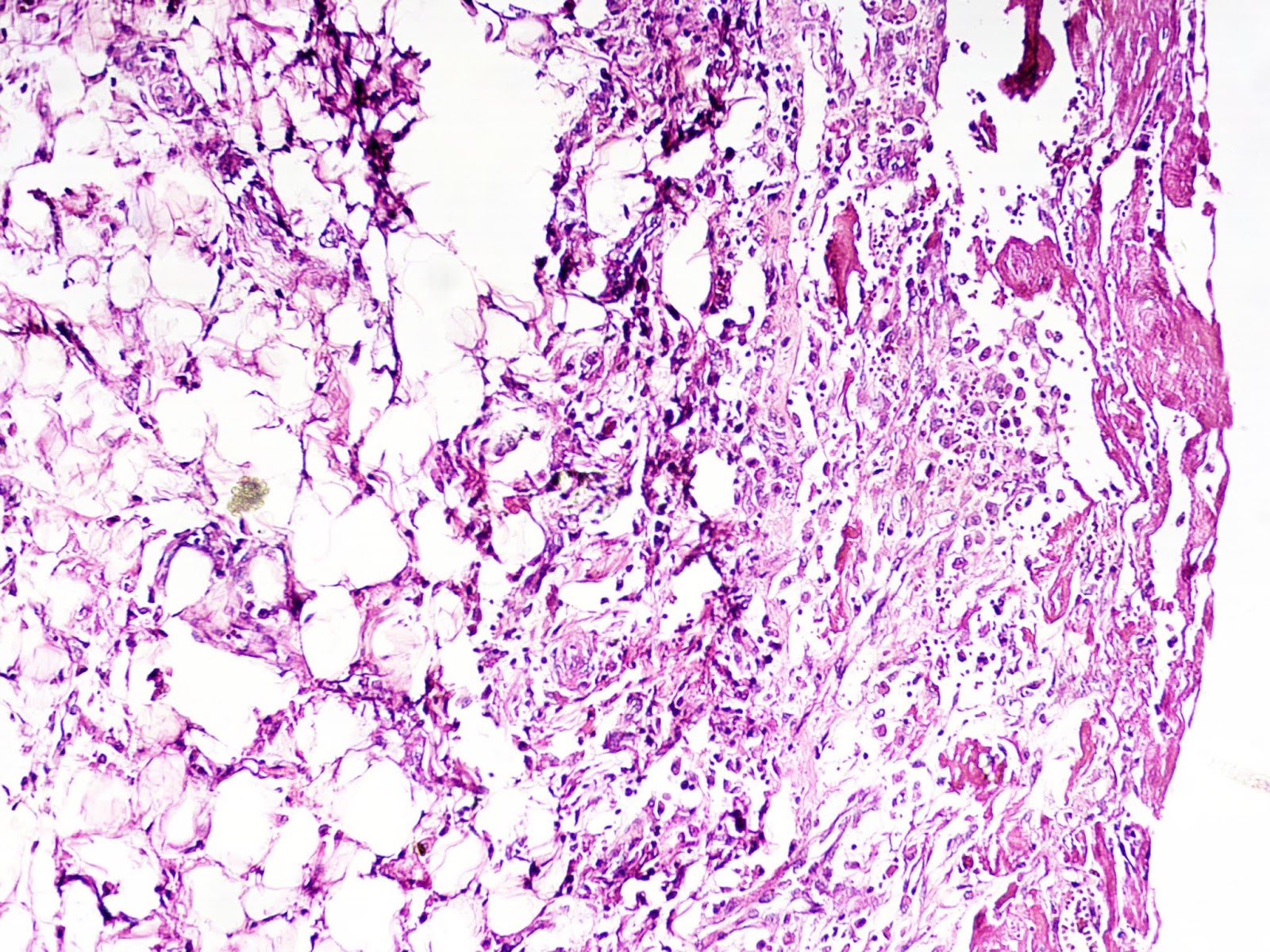 into the roots Pericarditis
