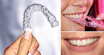 http://toothncare.com/invisible-braces.html