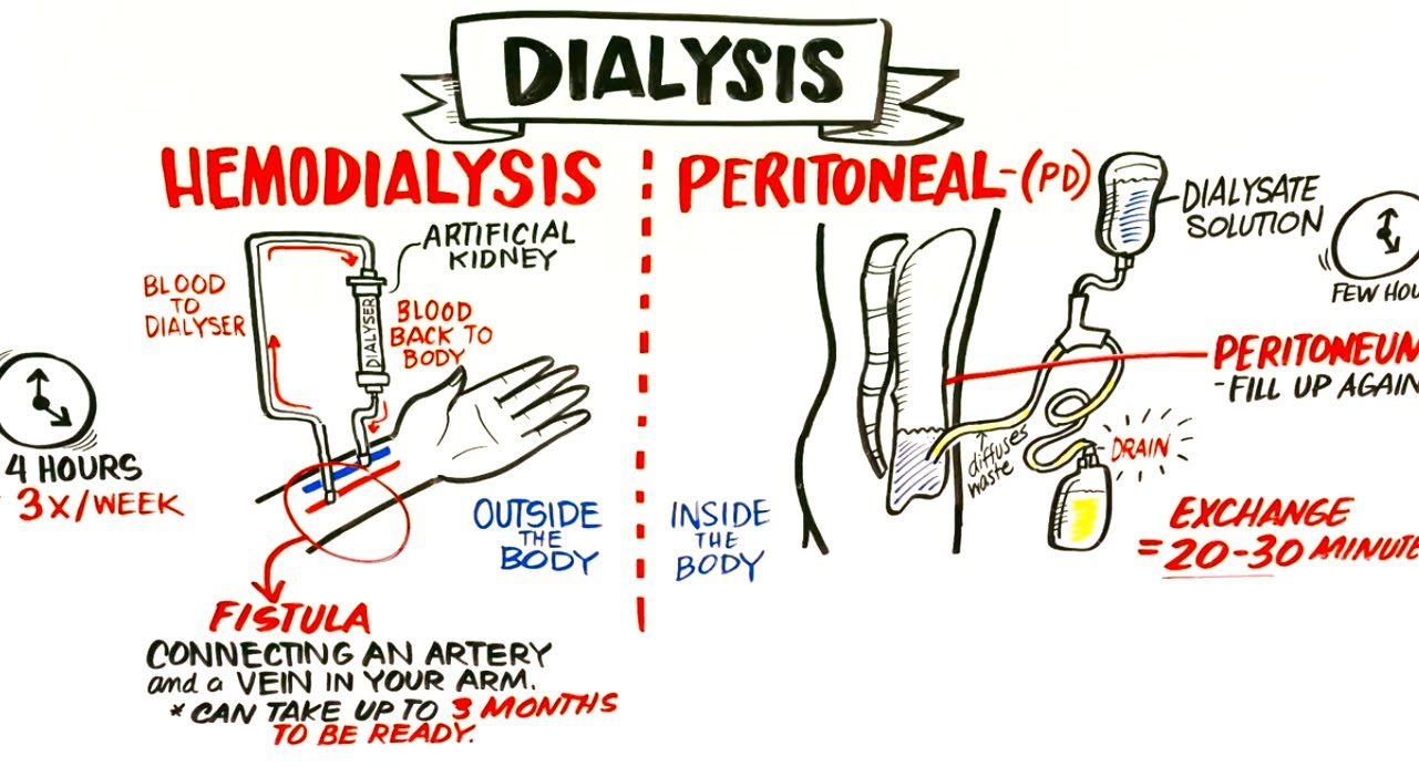 dialysis-organ-transplantation-nhs-blood-and-transplant