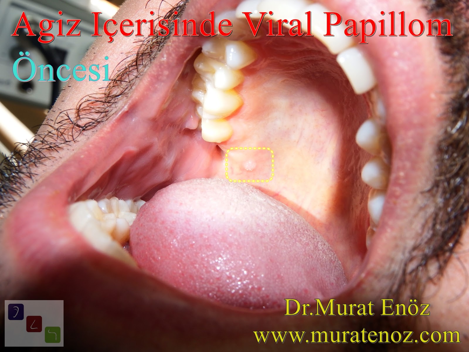 A HPV (humán papillomavírus) fertőzés tünetei, kezelése Papilloma száj okoz