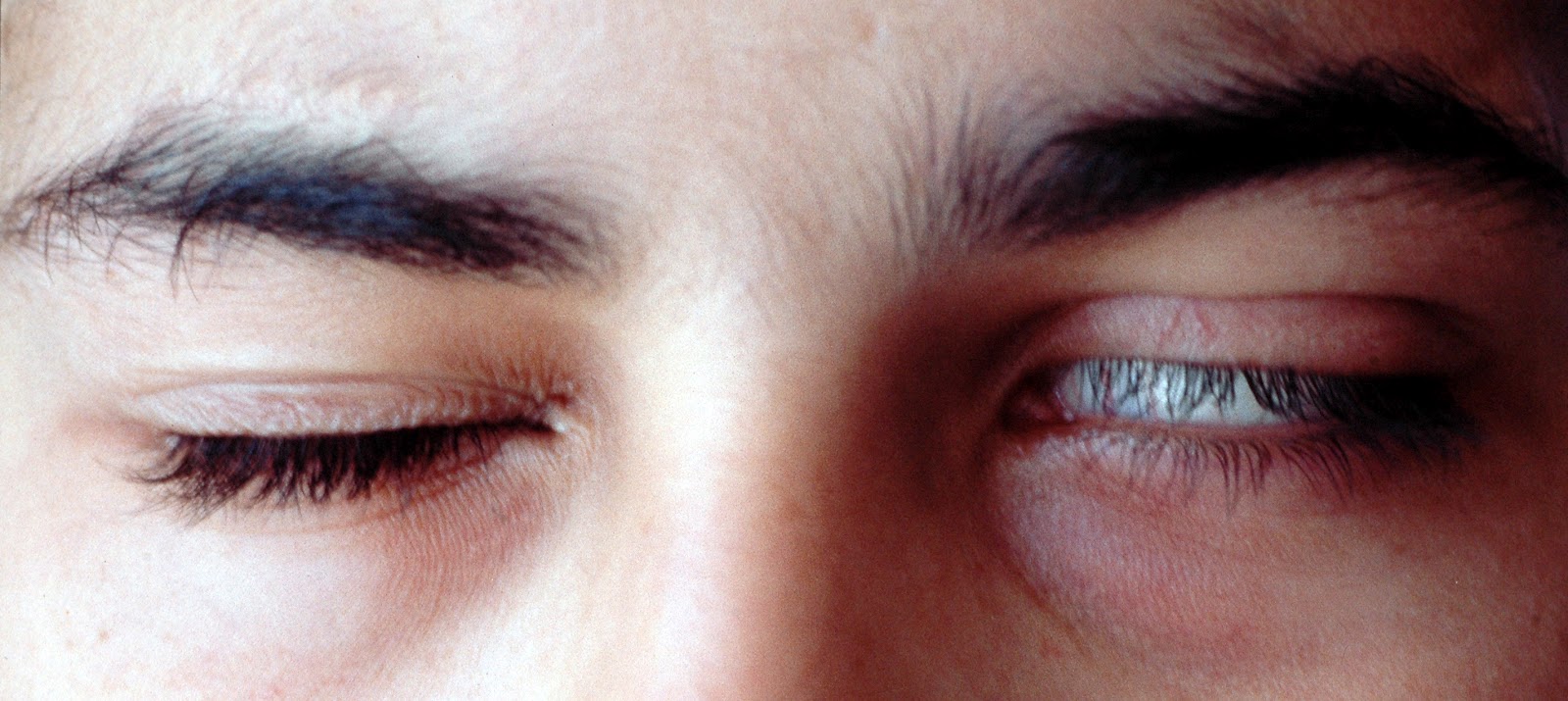 fenómeno ocular