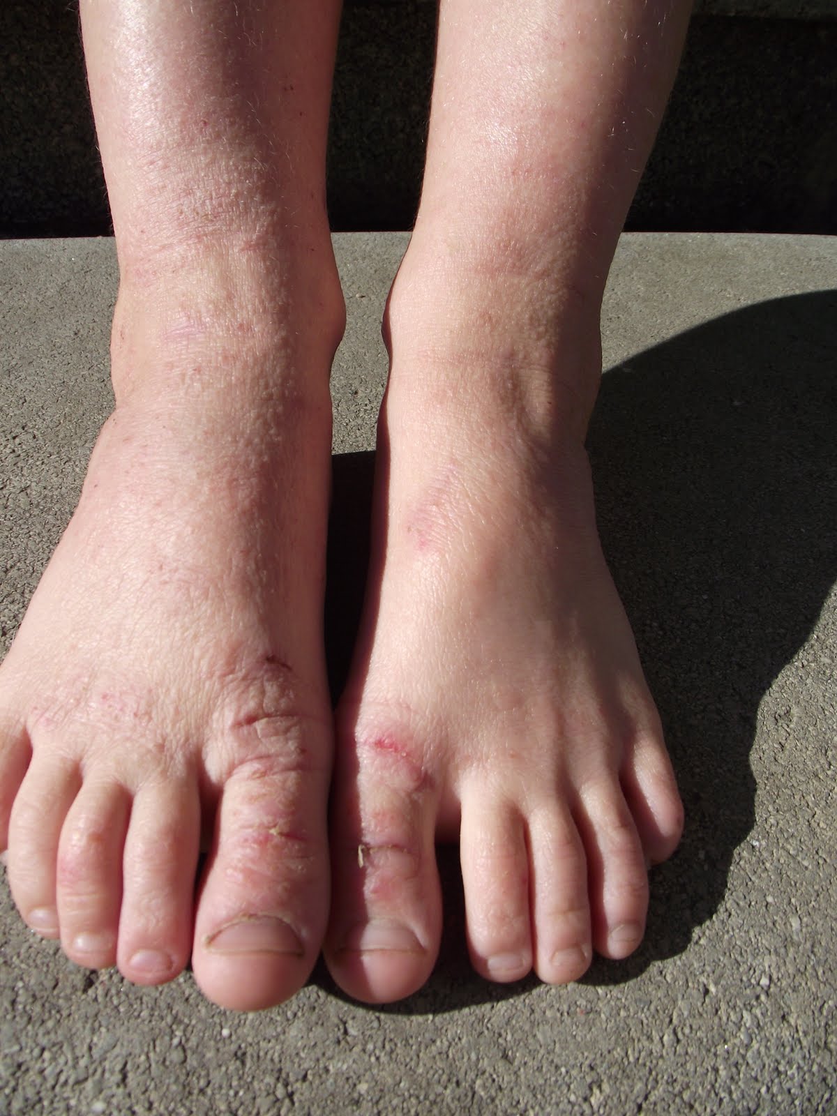 Green and Bitchy Green Tea for healing Atopic Allergic Reactions