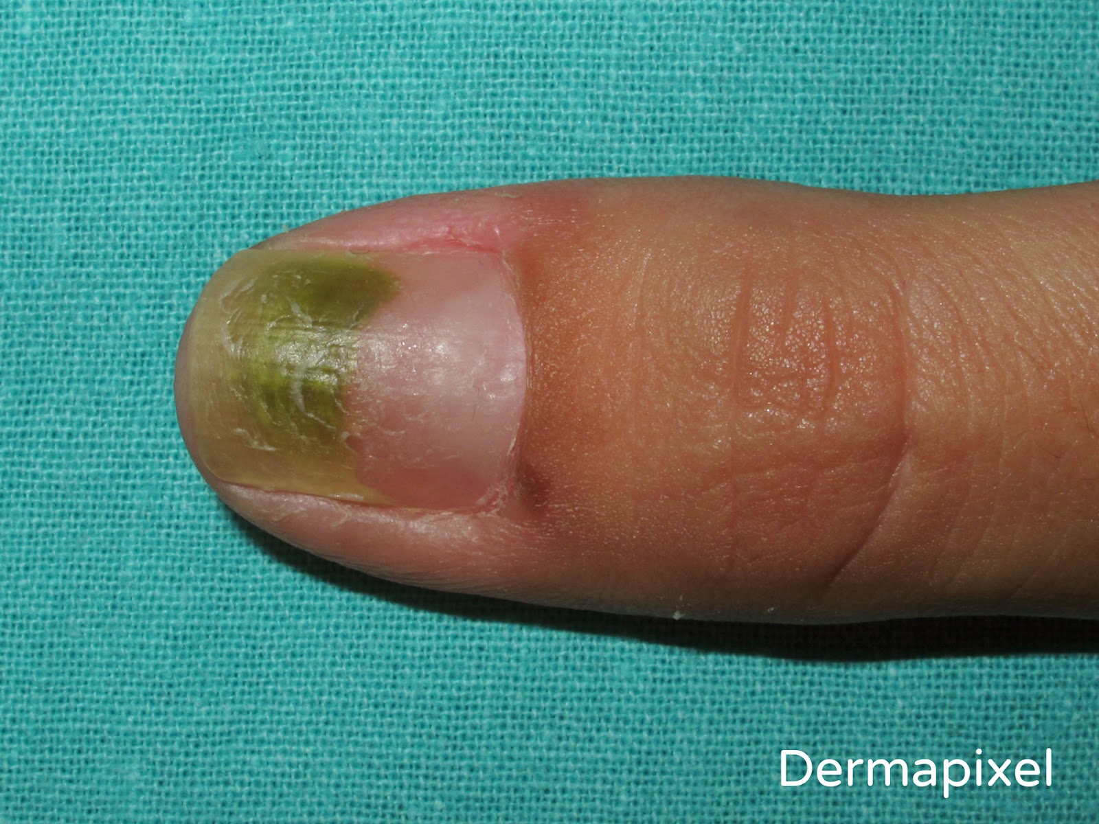 Dermapixel: Uñas verdes: a veces son Pseudomonas (y otras, no)