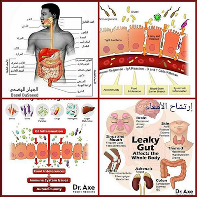 ارتشاح الأمعاء تهريب في الأمعاء Leaky Gut Syndrome و ج ن