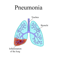 Penyebab dan gejala Pnemonia