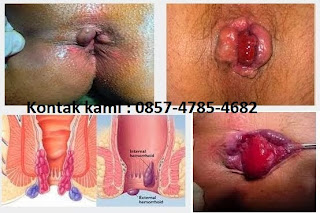 Stadium Wasir Parah cara mengatasi wasir rahma herbal, cara mengatasi wasir rahma farma, cara mengatasi wasir rahma online