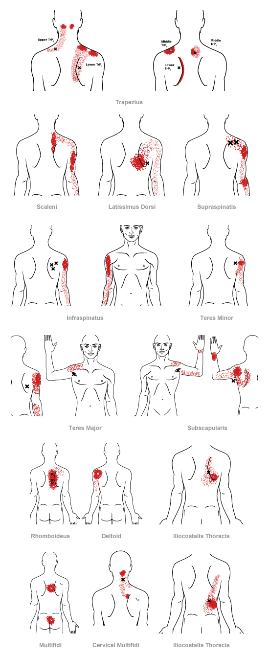 About Health Trigger point therapy