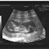 What is an Ultrasound?