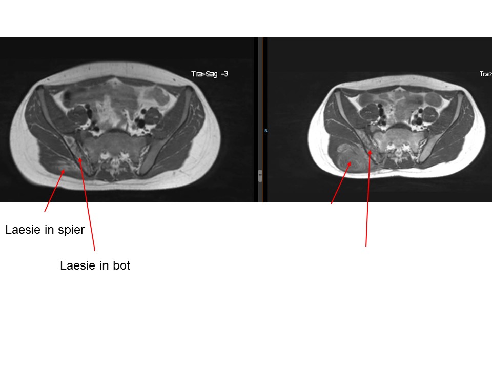 Rens: Uitslag MRI-scan