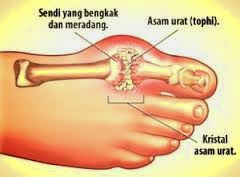 Sendi Bengkak Obat Sendi Bengkak