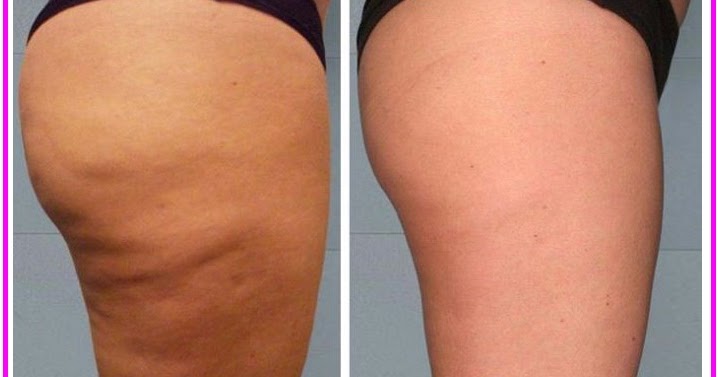 Cellulite: i 10 rimedi per eliminarla - Farmaco e Cura