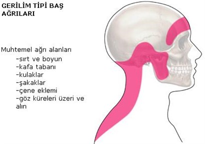 diyet klavuzu gerilim tipi bas agrisi