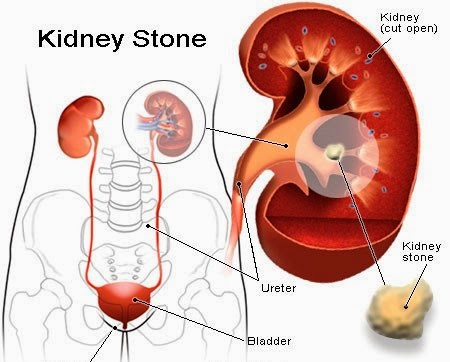 Kidney Stone Removal Homeo Treatment Clinic Chennai Tamil Nadu