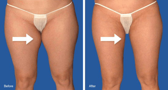 Lose Inner Thigh Fat At Home