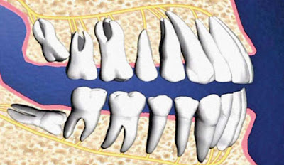 Biện pháp khắc phục răng khôn mọc lệch 