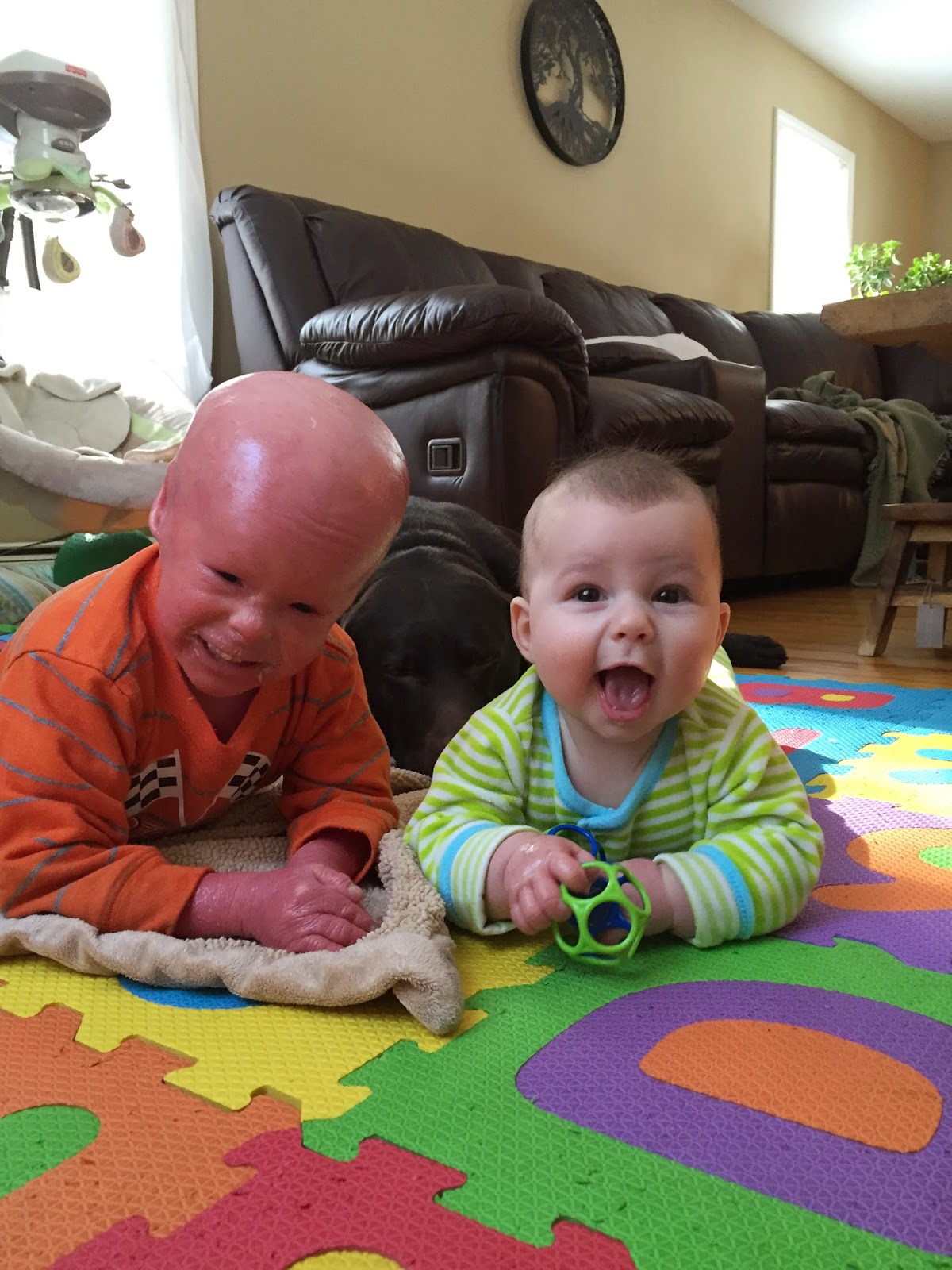 Evan, who has Harlequin Ichthyosis, with his brother