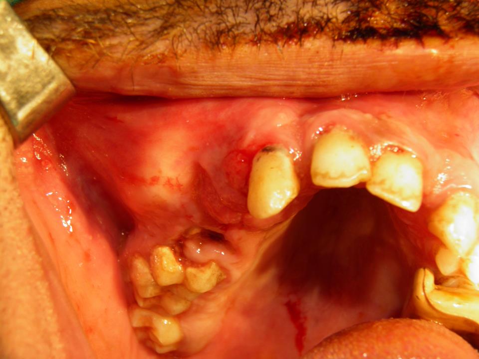 Desmoplastic ameloblastoma of Maxilla