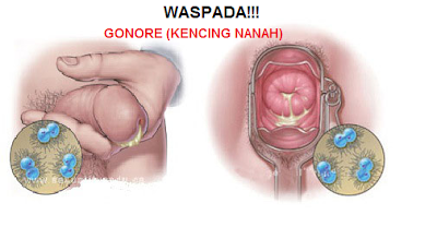 Obat Gonore Paling Ampuh Di Apotik