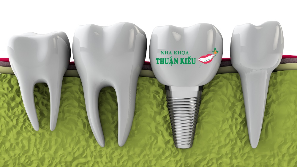 Dental Implants, Options For Missing Teeth Dental Implants in Vietnam
