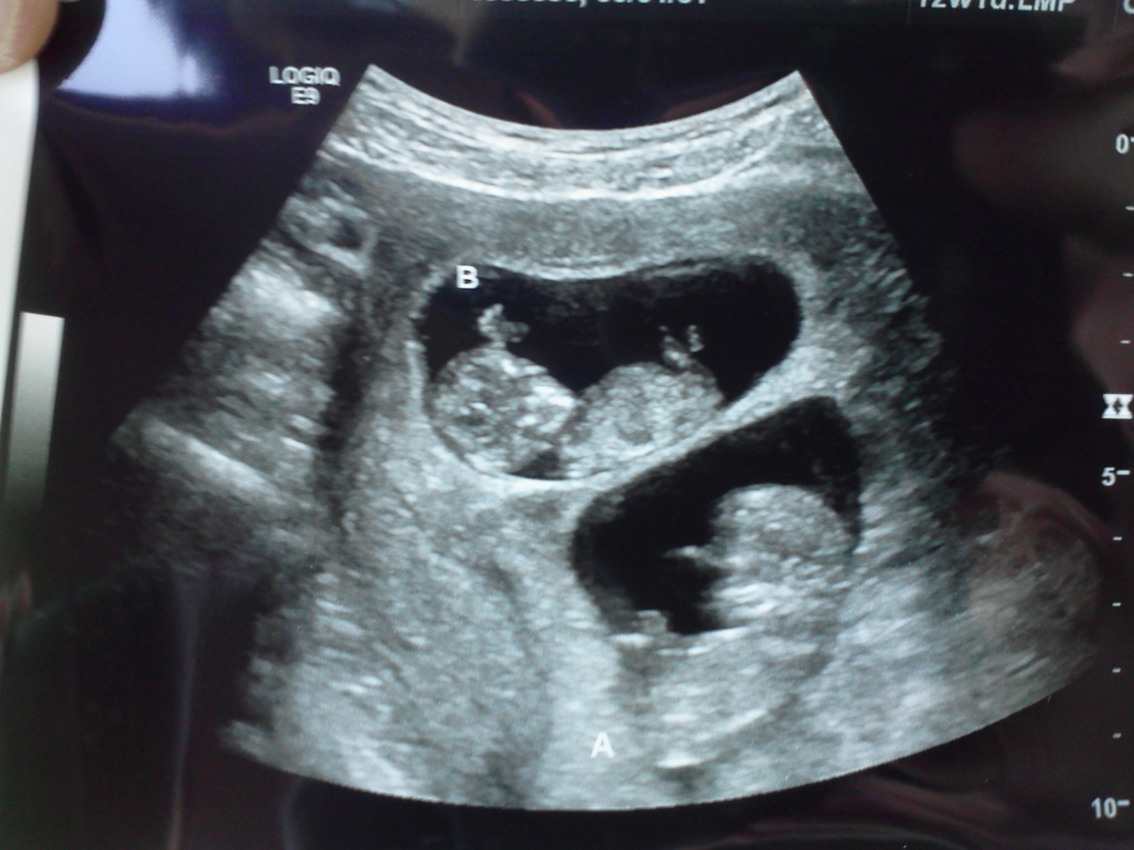 The Hart Family: 11 Week Ultrasound and Graduation Day!