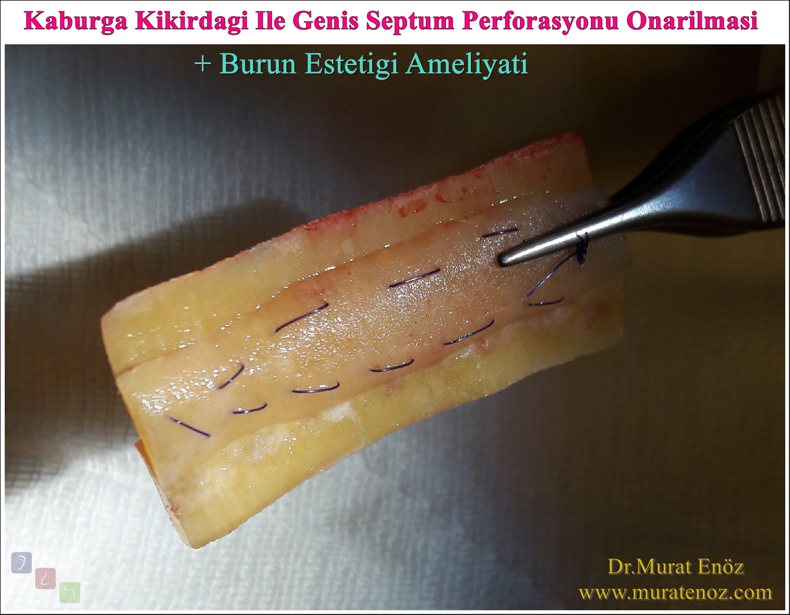 Health Zone Turkey Large Septum Perforation Repair And Rhinoplasty