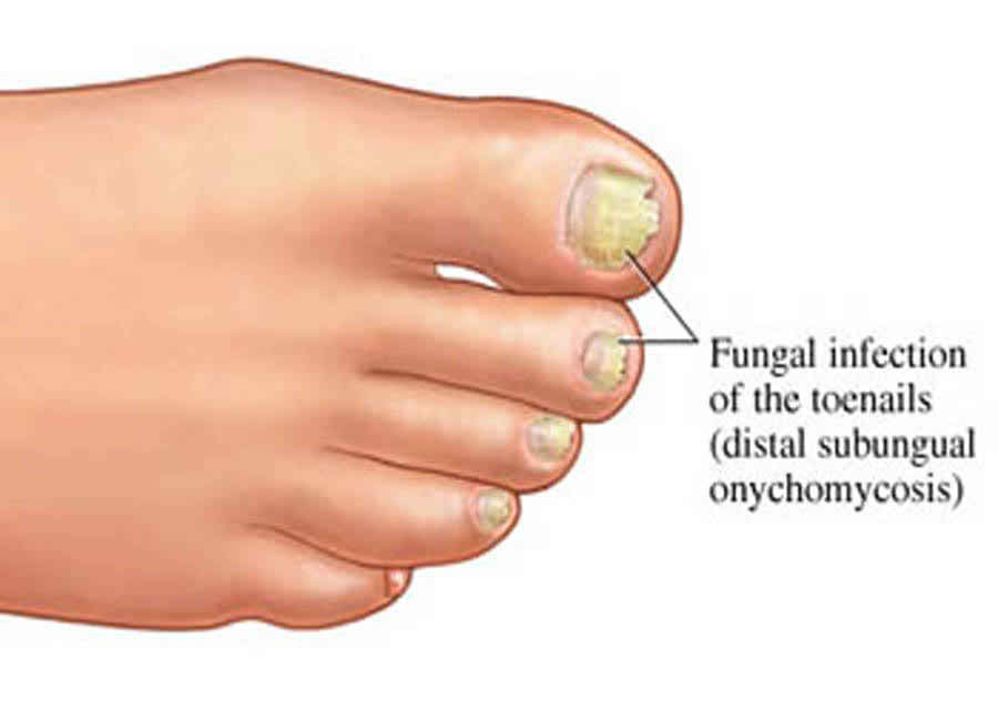 Fungal Nail Infection, like fungal infections can attack the skin, fungus can also affect the nails.