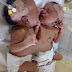 Nigerian Doctors Successfully Separate Conjoined Twins At Abuja Hospital 