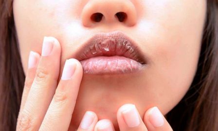 5 Cara Alami Mengatasi Bibir Pecah-Pecah