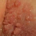 Pengertian Infeksi Hpv thumbnail