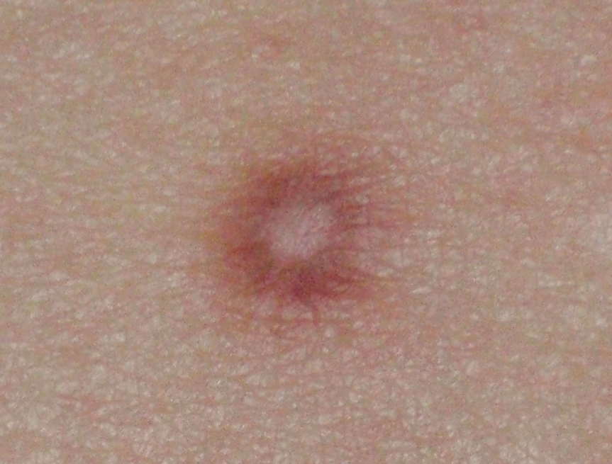 dermatofibroma-on-leg