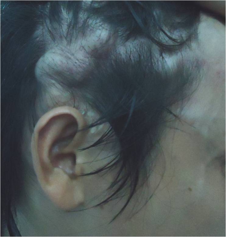 VIETNAMESE MEDIC ULTRASOUND CASE 180 AV FISTULA POST OP MIDDLE EAR