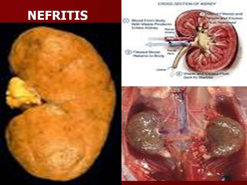 Infeksi Kuman Pada Nefritis Menyebabkan Kerusakan Ginjal Bagian Informasi Dunia Kesehatan