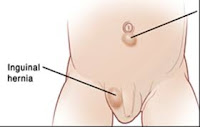 Cara Menyembuhkan Hernia Inguinalis