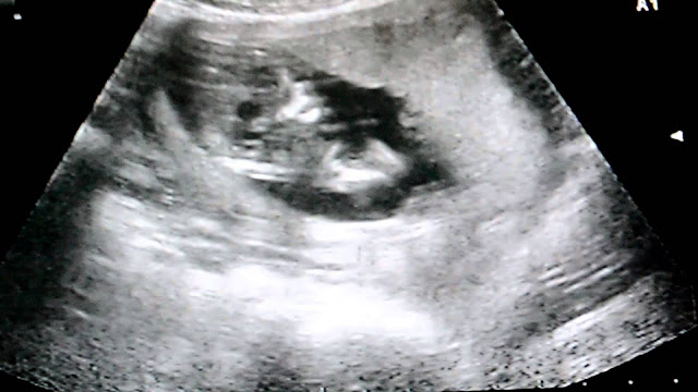 Populer 37+ Trimester Usia 4 Minggu