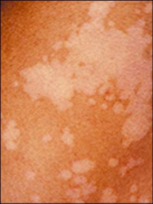 Secret Dark Skin Discoloration Patches Normal Skin