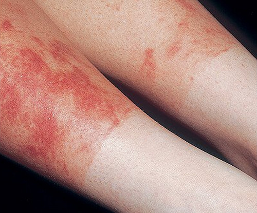 Sun Rash Pictures Medical Pictures And Images 2023 Updated