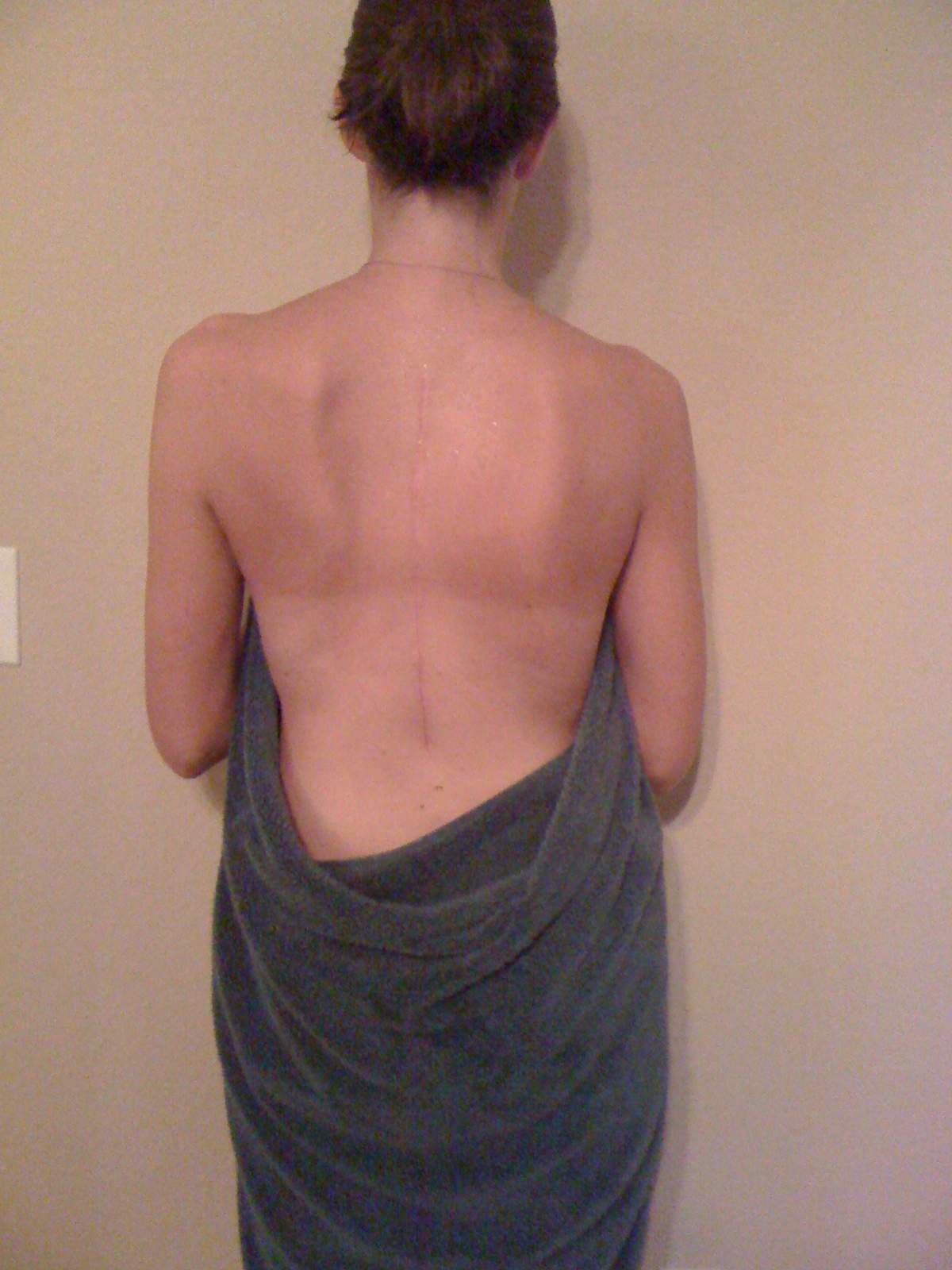 My scoliosis surgery journey