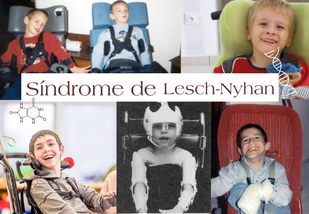 Síndrome de Lesch Nyhan 