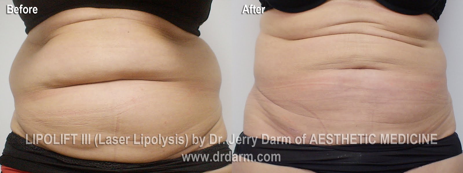 dr darm aesthetic medicine blog what is the slimlipo lake oswego laser light show