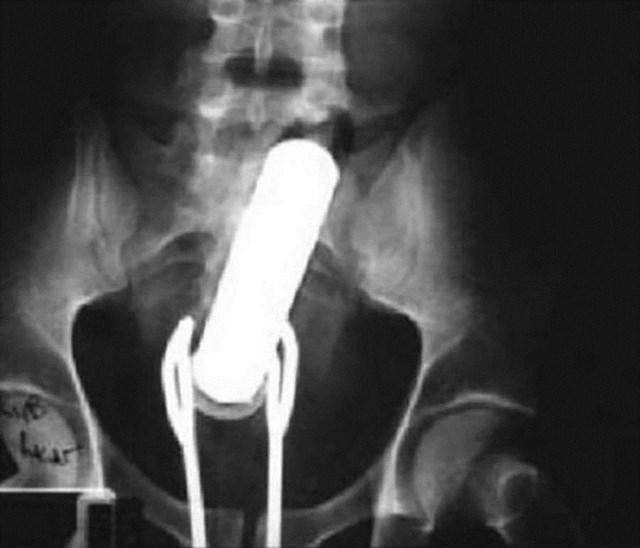 De anel a vibrador: veja os 6 objetos mais estranhos já encontrados em raios X De anel a vibrador: veja os 6 objetos mais estranhos já encontrados em raios X
