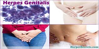 https://4.bp.blogspot.com/-c308738LWq0/WOh_q5M65BI/AAAAAAAAAbA/RLo0YnRnPEoSKN1w353I9eUWQfp5Ci1yACLcB/s1600/herpes%2Bdos.jpg