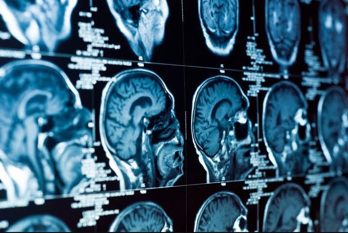 Trauma cranico diagnosticato con una goccia di sangue.