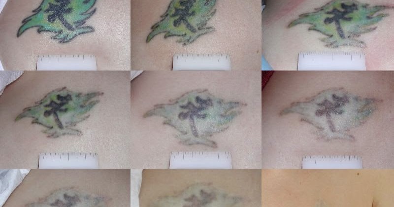 8. Tattoo Removal with Lemon Juice - wide 8