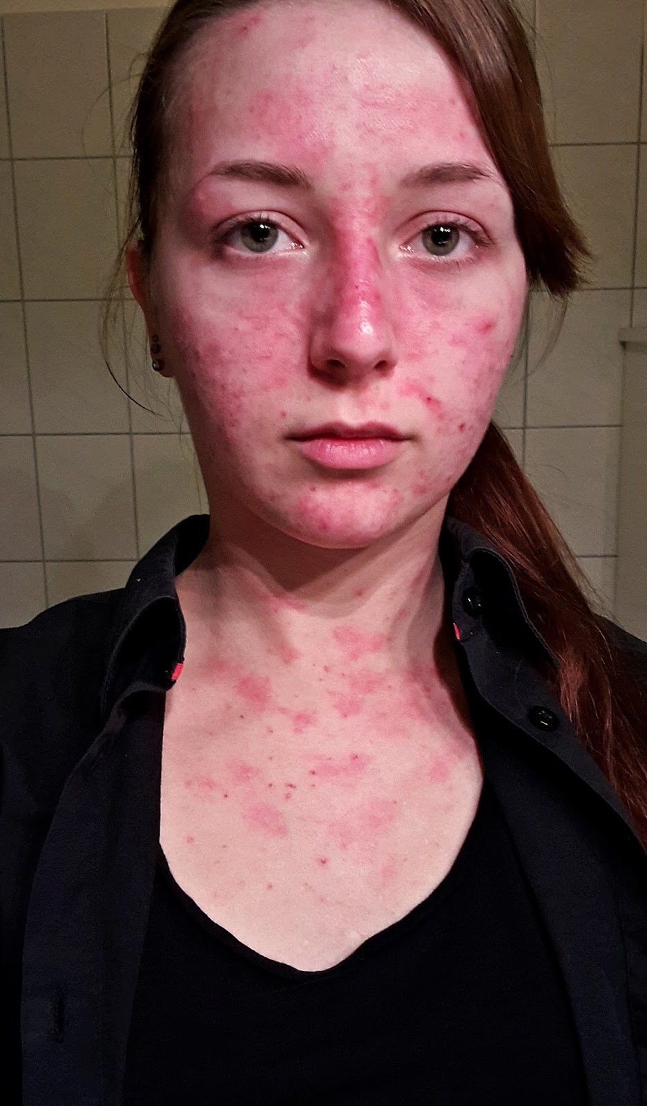 Mein Leben mit Skin Picking/Dermatillomanie: Alles rot